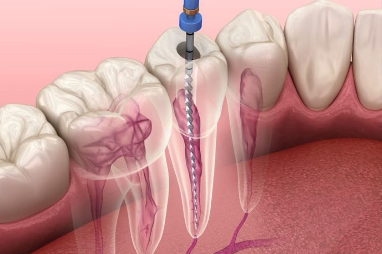 Painless root canal treatment Gachibowli