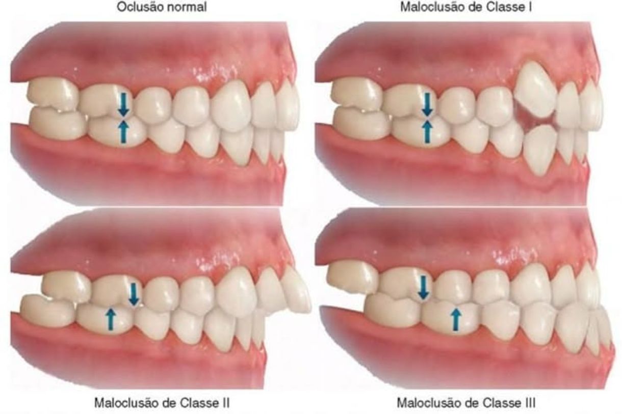 Bite and malocclusion correction Gachibowli