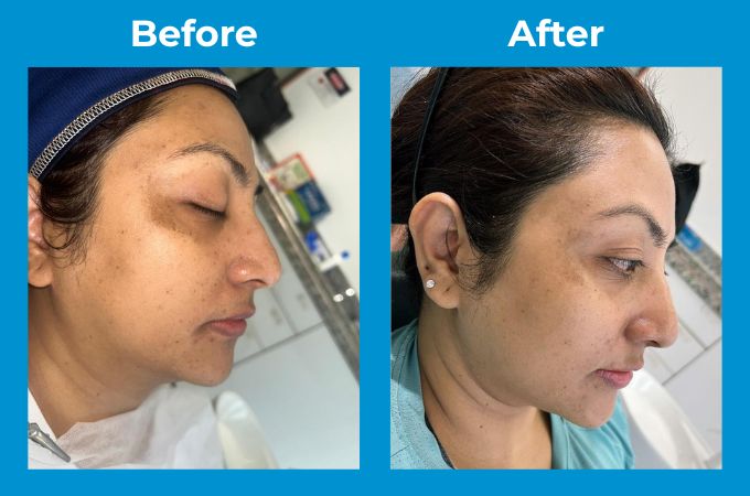 Skin Pigmentation