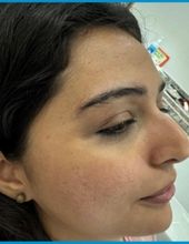 Acne scar treatment — after at Ogha Health Gachibowli