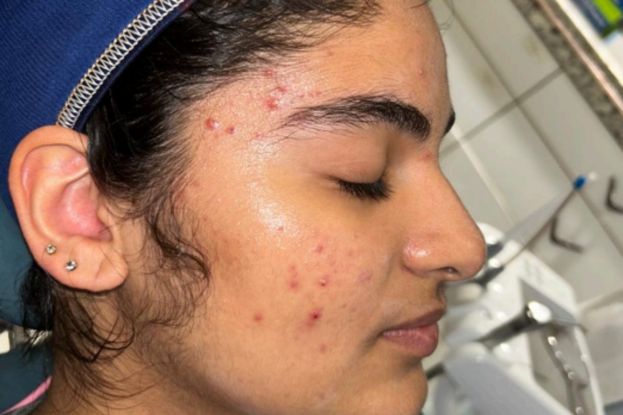 Acne & Acne Scarring