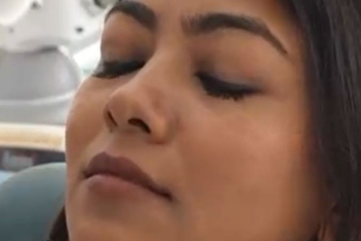 Laser Face Lift & Skin Tightening