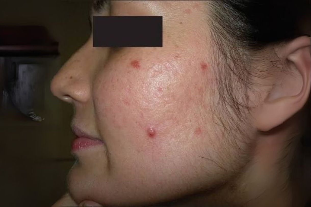 PCOS-related Skin & Hair Issues
