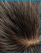 GFC PRP hair restoration — after treatment at Ogha Health Gachibowli