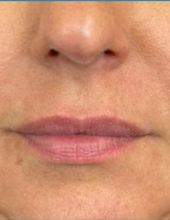 Lip plumping — before treatment