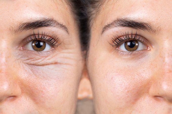 PRP & Smooth Lase for Expression Lines