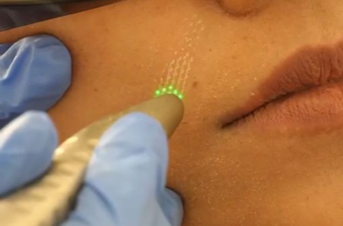 Laser Skin Resurfacing